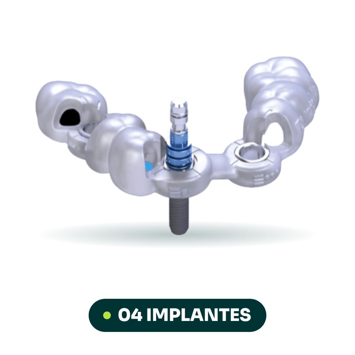 Cirurgia Guiada Parcial (04 implantes)