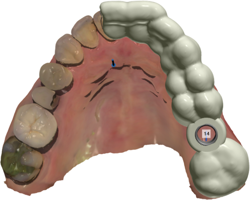 Cirurgia Guiada 01 elemento